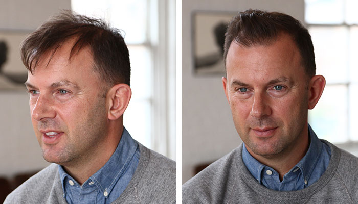 how long to regrow hairline